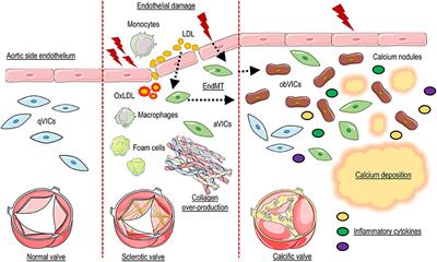 The Complex Interplay of Inflammation, Metabolism, Epigenetics, and Sex in Calcific Disease of the Aortic Valve
